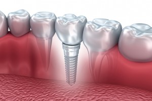 alexmit151200016.jpg - tooth human implant, 3d illustration